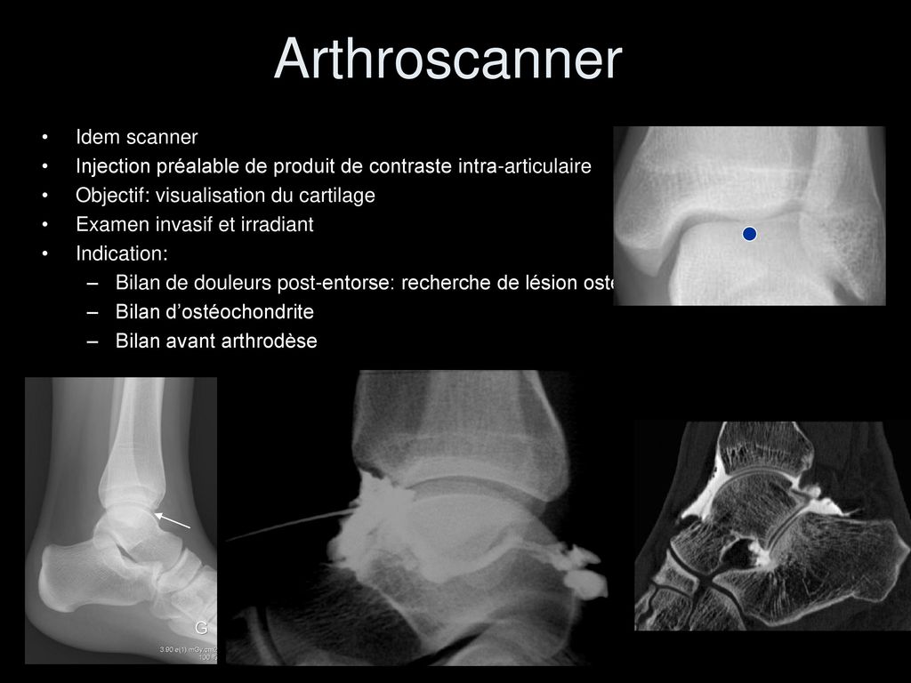 Radioanatomie de la cheville ppt t l charger